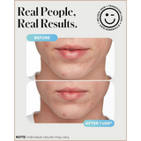 Rapid Acne Spot Treatment with Sulfur & Salicylic Acid for Breakout Reduction